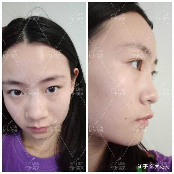 最新隆鼻技术揭秘，奇妙之旅启程